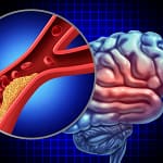 Miranda Sarmento terá sofrido Acidente Isquémico Transitório. O que é?