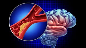 Miranda Sarmento terá sofrido Acidente Isquémico Transitório. O que é?