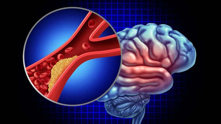 Miranda Sarmento terá sofrido Acidente Isquémico Transitório. O que é?