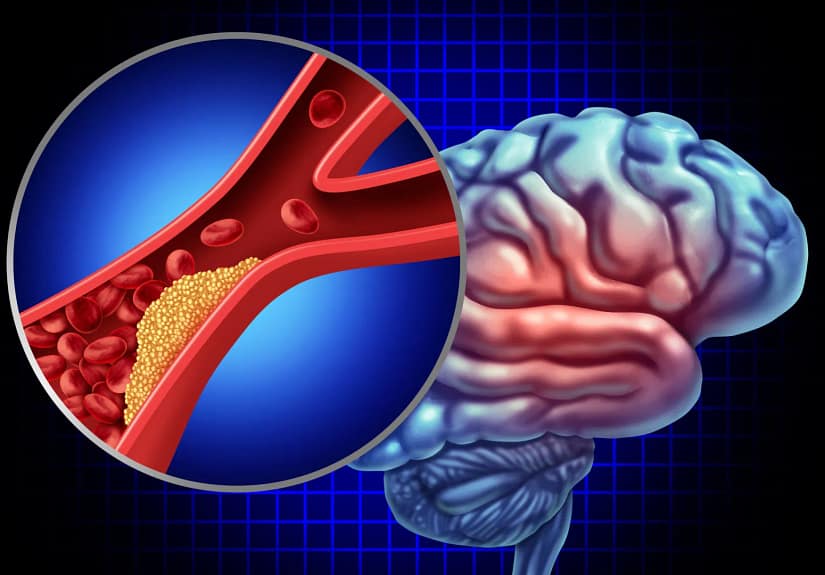 Miranda Sarmento terá sofrido Acidente Isquémico Transitório. O que é?
